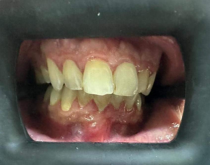 Whitening before